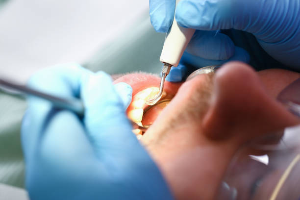 Best Knocked-Out Tooth (Avulsed Tooth) Treatment in Fairview Ferndale, PA
