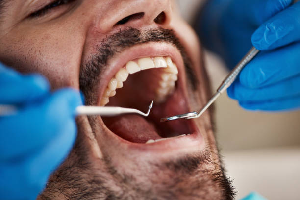 Best Dental Abscess Treatment in Fairview Ferndale, PA